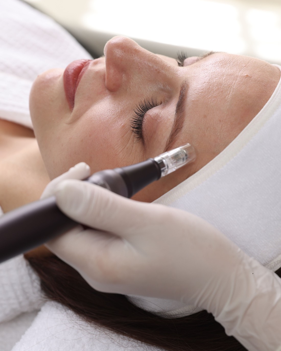 Derma Pen microneedling device gliding over a client's cheek during treatment